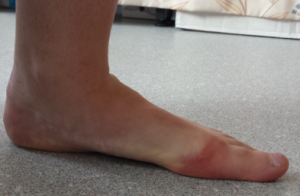 Flat Foot